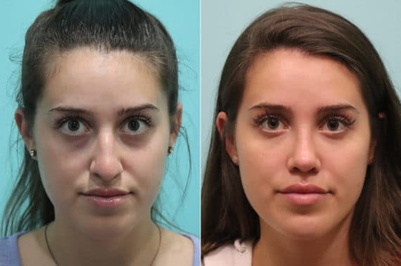 Before and after Rhinoplasty by Dr. Shervin Naderi, Patient 22936