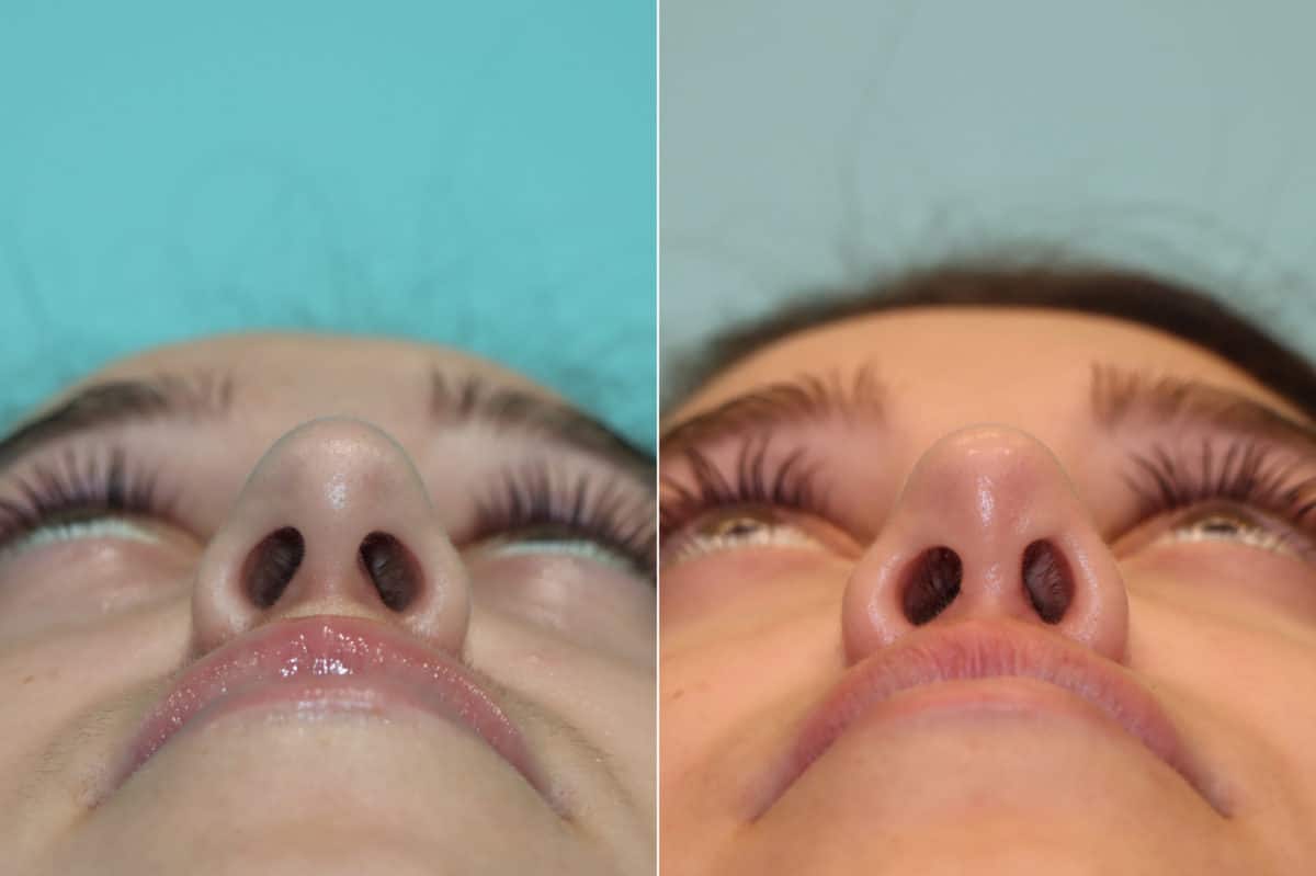 Before and after Rhinoplasty by Dr. Shervin Naderi, Patient 22936