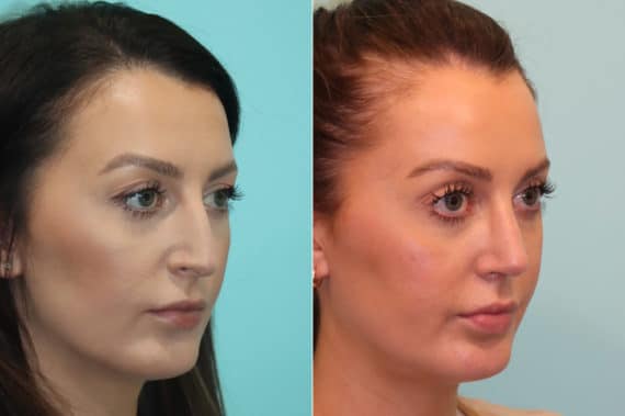 Before and after Rhinoplasty by Dr. Shervin Naderi, Patient 22985