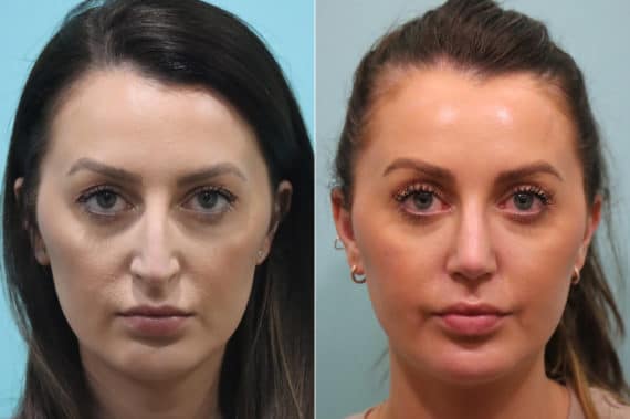 Before and after Rhinoplasty by Dr. Shervin Naderi, Patient 22985