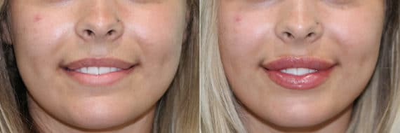 Before and after Lip Augmentation by Dr. Shervin Naderi, Patient 23015