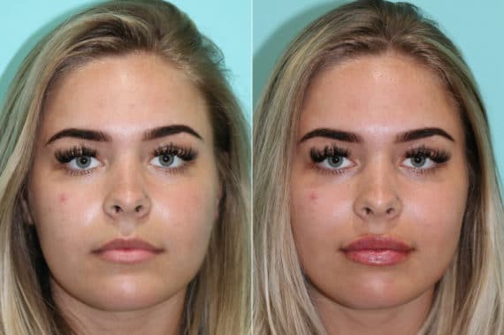 Before and after Lip Augmentation by Dr. Shervin Naderi, Patient 23015