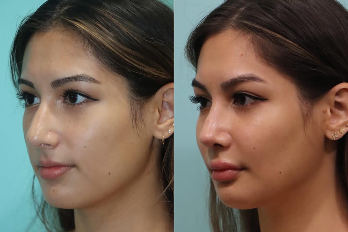 Before and after Rhinoplasty by Dr. Shervin Naderi, Patient 23022