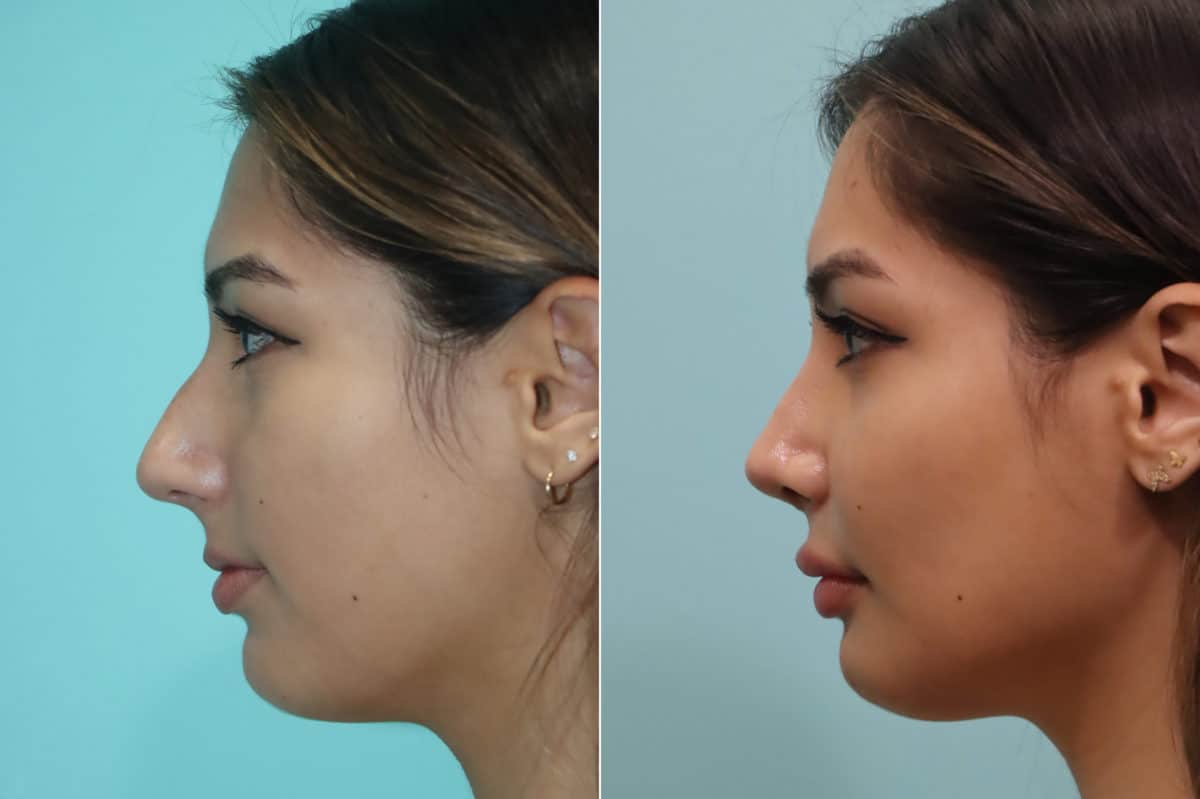 Before and after Rhinoplasty by Dr. Shervin Naderi, Patient 23022