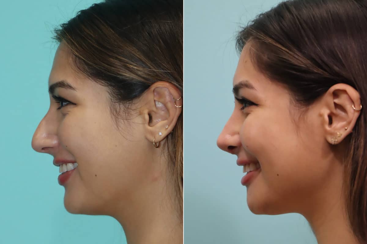 Before and after Rhinoplasty by Dr. Shervin Naderi, Patient 23022