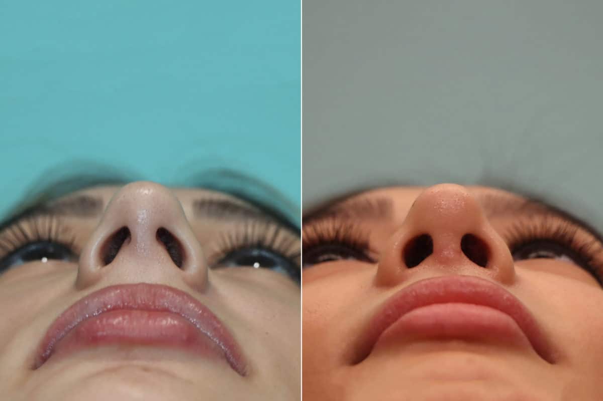 Before and after Rhinoplasty by Dr. Shervin Naderi, Patient 23022