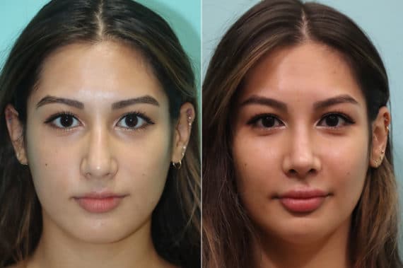 Before and after Rhinoplasty by Dr. Shervin Naderi, Patient 23022