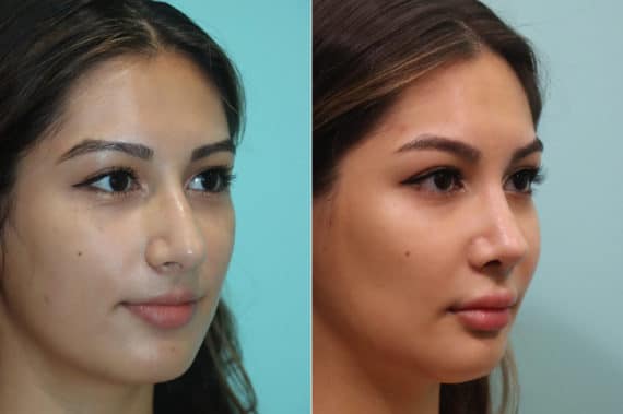 Before and after Rhinoplasty by Dr. Shervin Naderi, Patient 23022