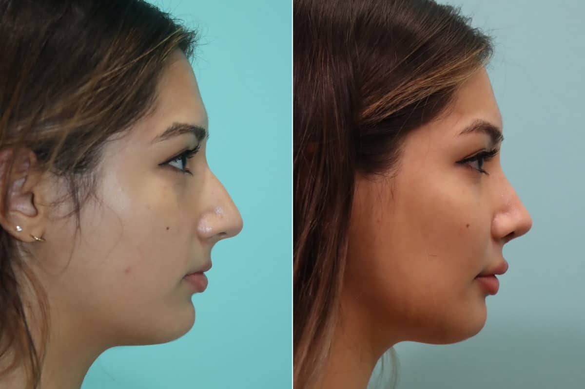 Before and after Rhinoplasty by Dr. Shervin Naderi, Patient 23022