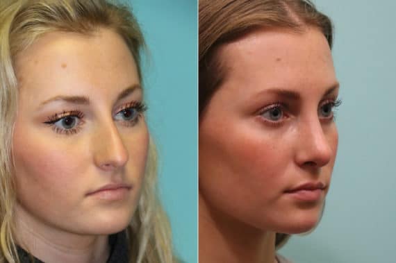 Before and after Rhinoplasty by Dr. Shervin Naderi, Patient 23051