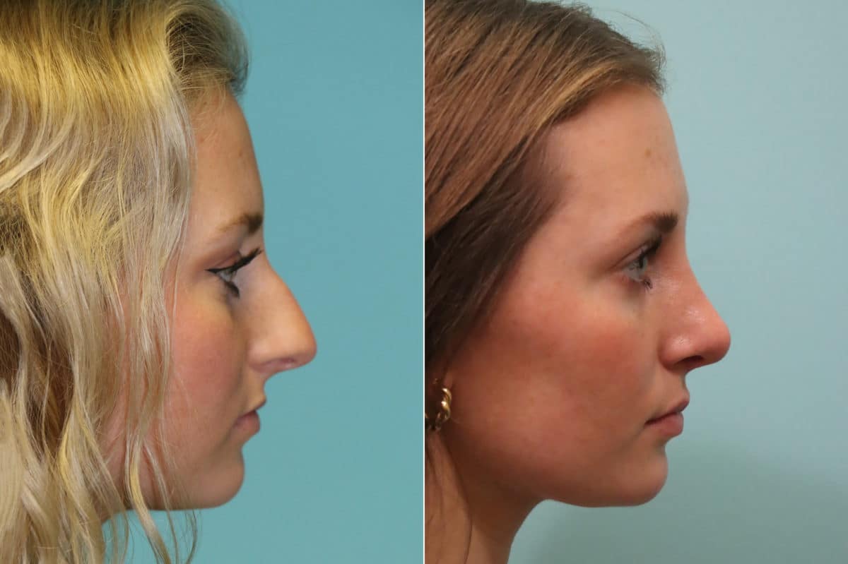 Before and after Rhinoplasty by Dr. Shervin Naderi, Patient 23051