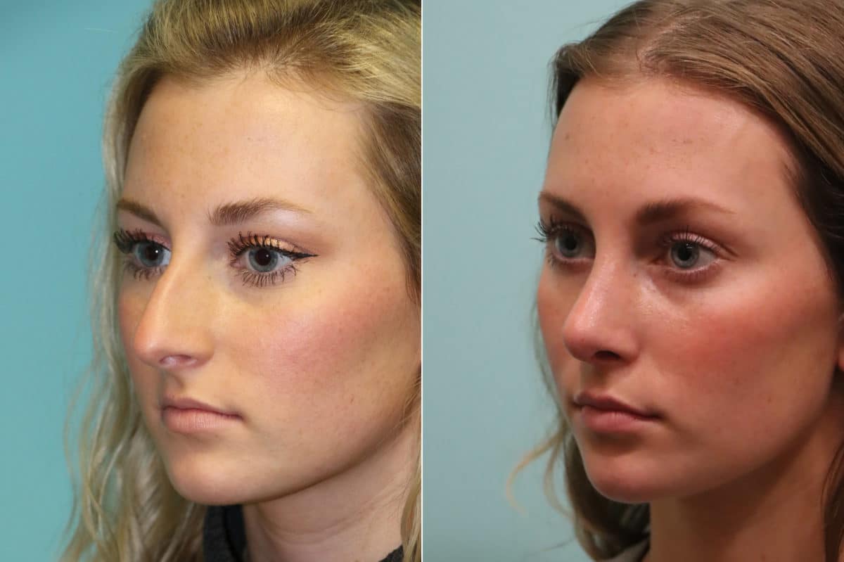 Before and after Rhinoplasty by Dr. Shervin Naderi, Patient 23051