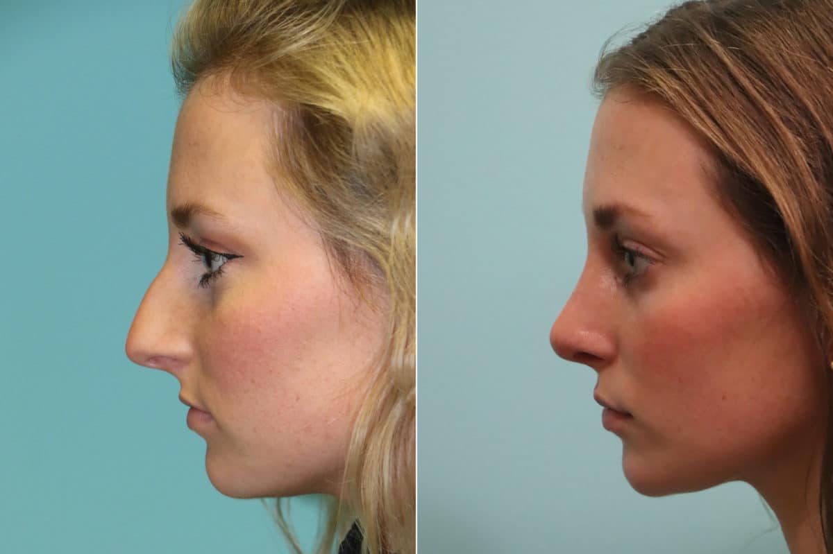 Before and after Rhinoplasty by Dr. Shervin Naderi, Patient 23051