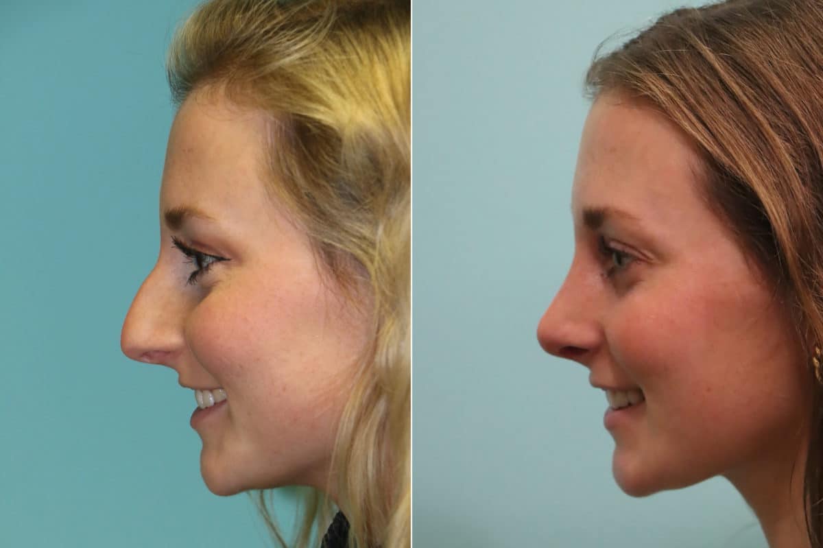 Before and after Rhinoplasty by Dr. Shervin Naderi, Patient 23051