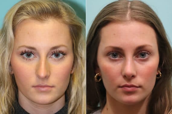 Before and after Rhinoplasty by Dr. Shervin Naderi, Patient 23051