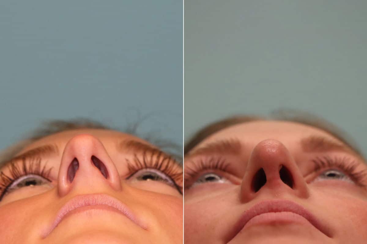 Before and after Rhinoplasty by Dr. Shervin Naderi, Patient 23051