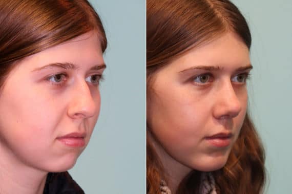 Before and after Chin & Facial Implant by Dr. Shervin Naderi, Patient 23073