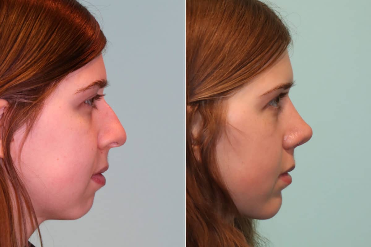 Before and after Chin & Facial Implant by Dr. Shervin Naderi, Patient 23073