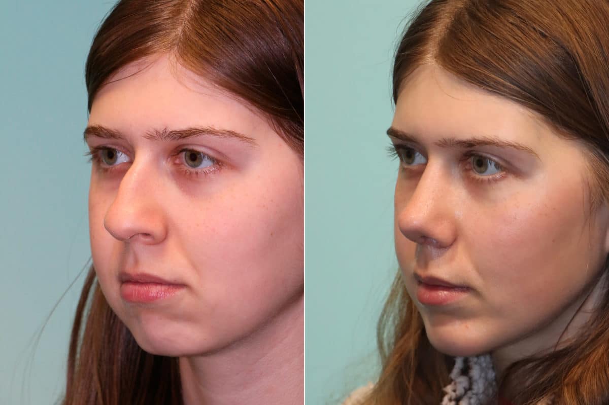 Before and after Chin & Facial Implant by Dr. Shervin Naderi, Patient 23073