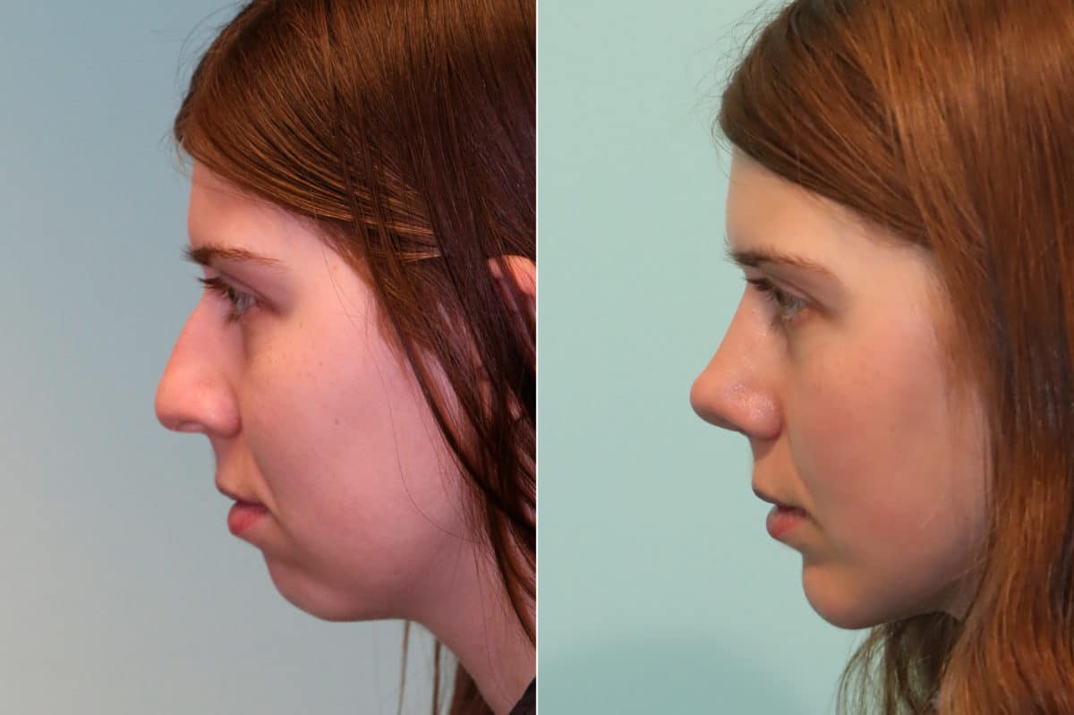 Before and after Chin & Facial Implant by Dr. Shervin Naderi, Patient 23073