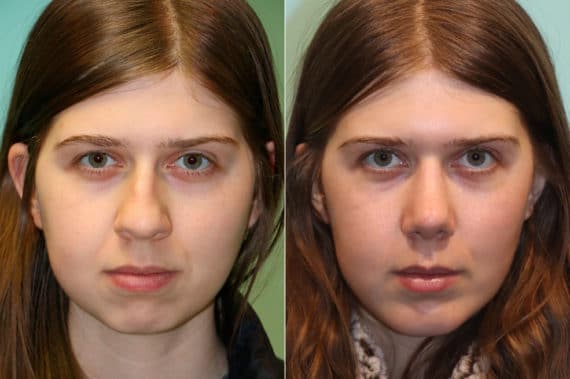 Before and after Chin & Facial Implant by Dr. Shervin Naderi, Patient 23073