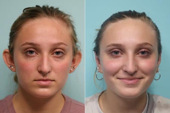 Before and after Otoplasty by Dr. Shervin Naderi, Patient 23089