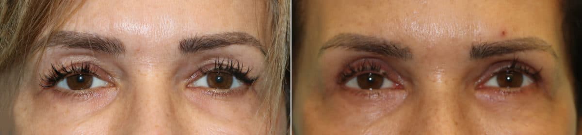 Before and after Blepharoplasty by Dr. Shervin Naderi, Patient 23154