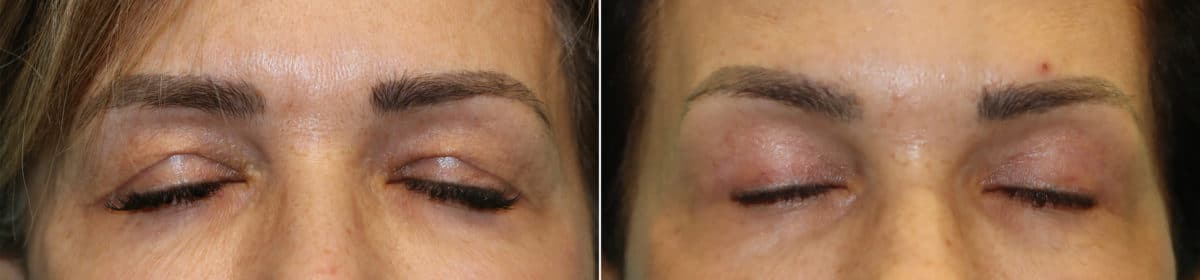 Before and after Blepharoplasty by Dr. Shervin Naderi, Patient 23154