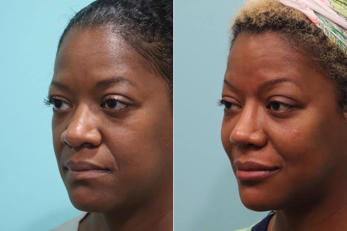 Patient 23178, Cheeks / Midface Injections Before and After Photos Before and after Cheeks / Midface Injections by Dr. Shervin Naderi, Patient 23178