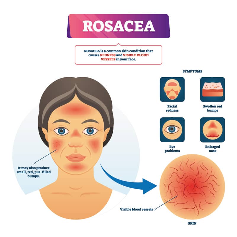 There are various clinical signs and symptoms that can suggest you have rosacea.  A dermatologist or trained physician will be able to make an accurate diagnosis and start an effective