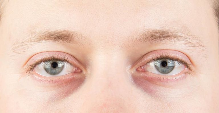 Close-up of the under-eye area