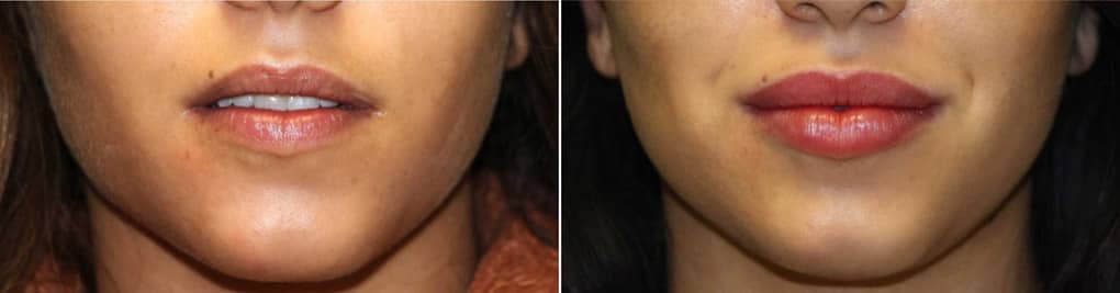 More noticeable lip augmentation in attractive female that already had full lips in reston virginia at The Naderi Center in Virginia and Maryland