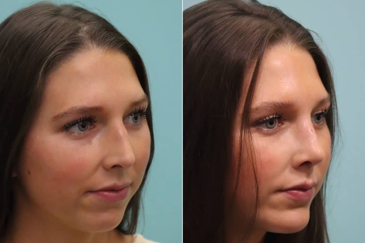 Before and after Rhinoplasty by Dr. Shervin Naderi, Patient 23374