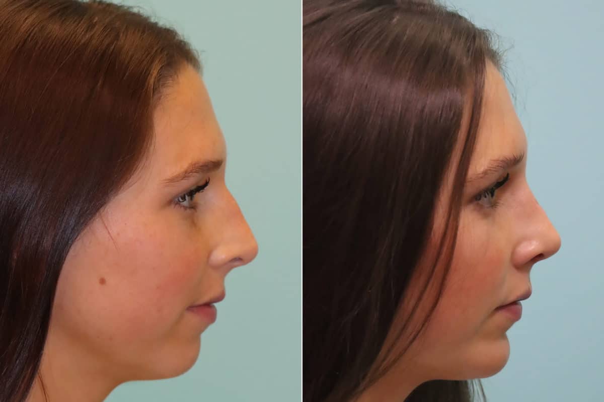 Before and after Rhinoplasty by Dr. Shervin Naderi, Patient 23374