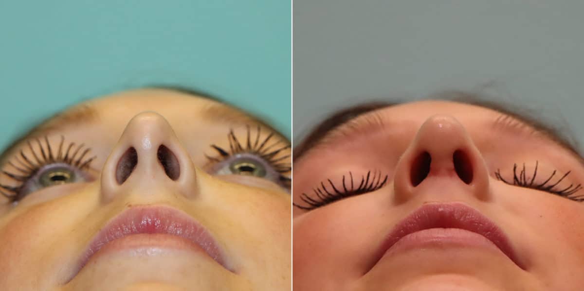 Before and after Rhinoplasty by Dr. Shervin Naderi, Patient 23374