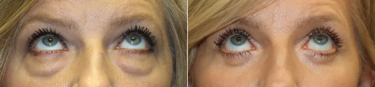 Before and after Blepharoplasty by Dr. Shervin Naderi, Patient 23428