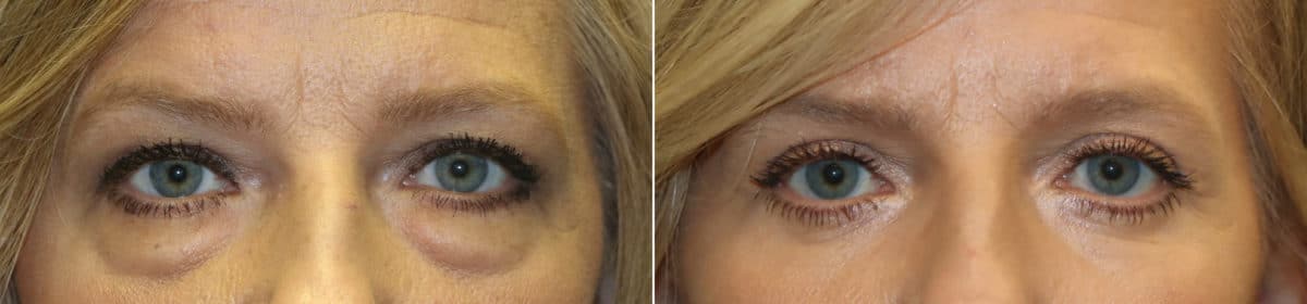 Before and after Blepharoplasty by Dr. Shervin Naderi, Patient 23428