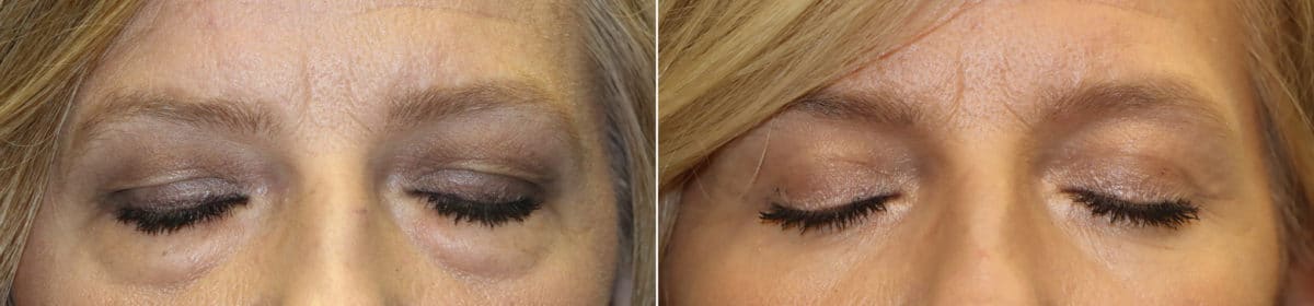 Before and after Blepharoplasty by Dr. Shervin Naderi, Patient 23428