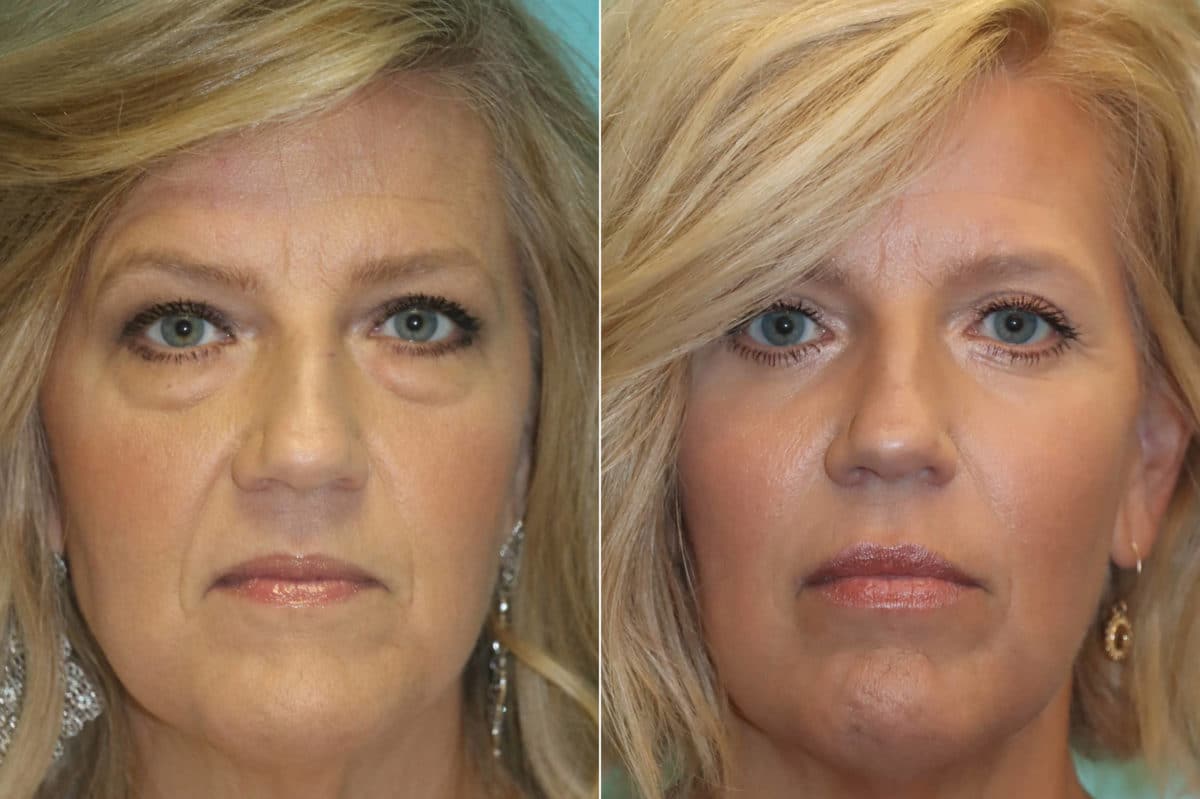 Before and after Blepharoplasty by Dr. Shervin Naderi, Patient 23428