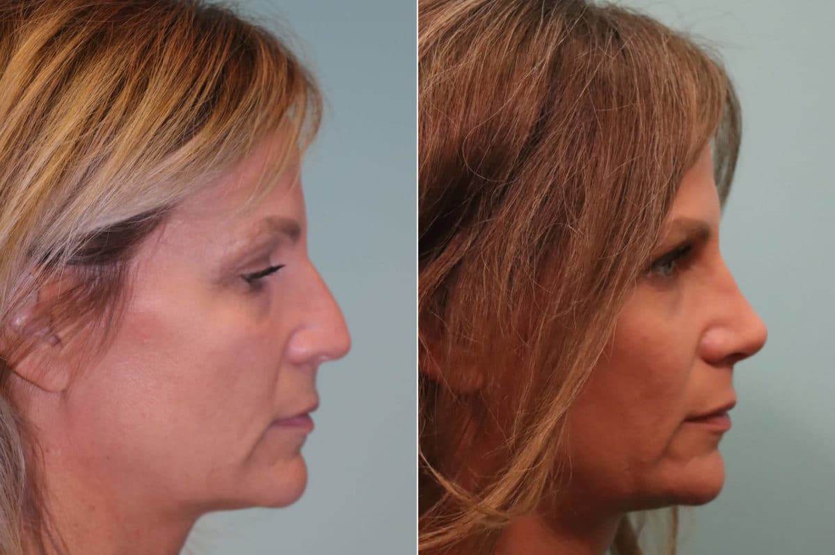 Before and after Rhinoplasty by Dr. Shervin Naderi, Patient 23470