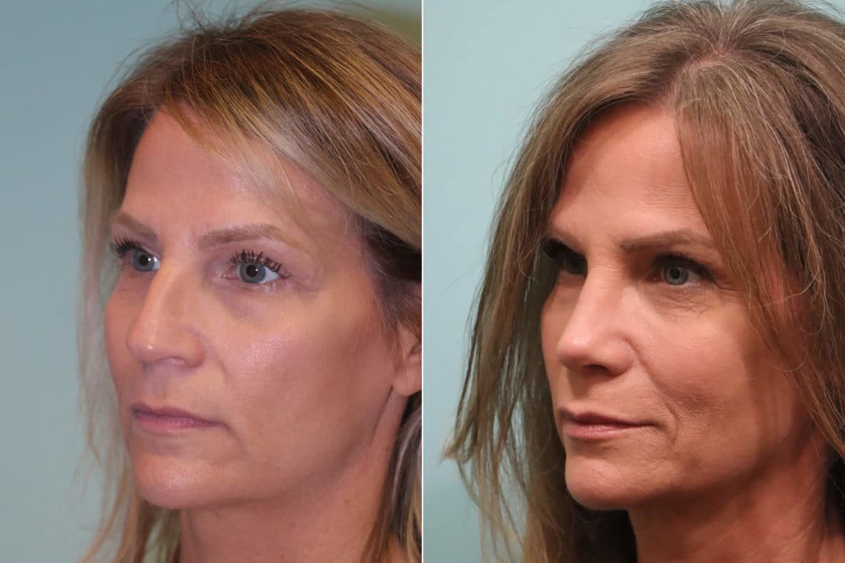 Before and after Rhinoplasty by Dr. Shervin Naderi, Patient 23470