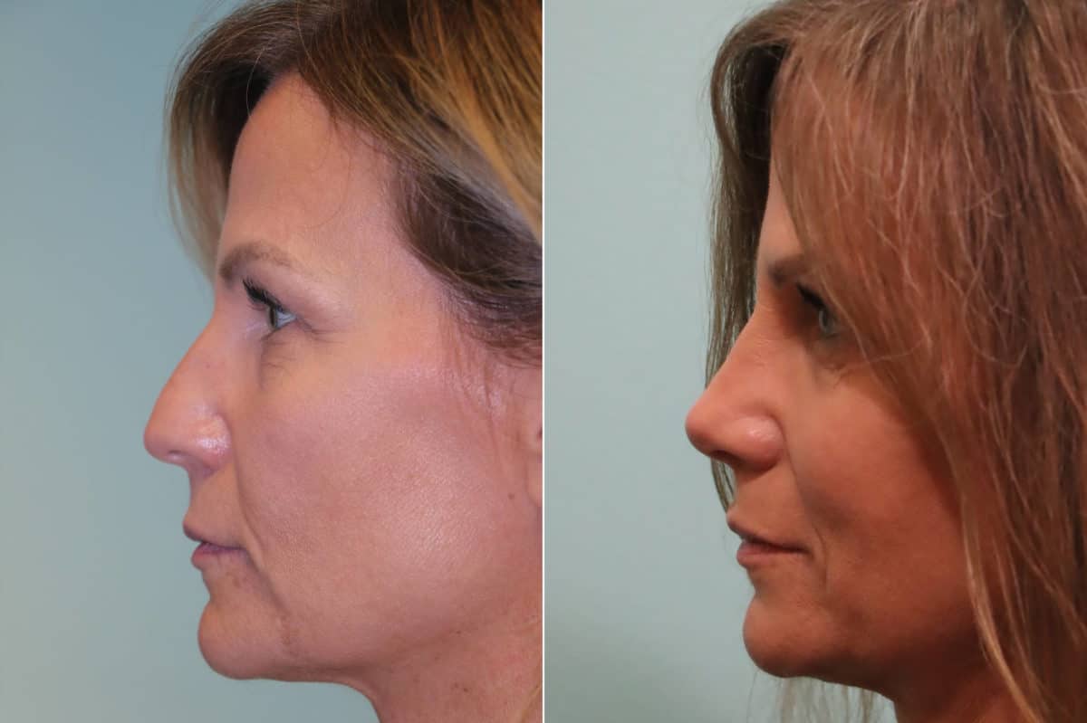 Before and after Rhinoplasty by Dr. Shervin Naderi, Patient 23470