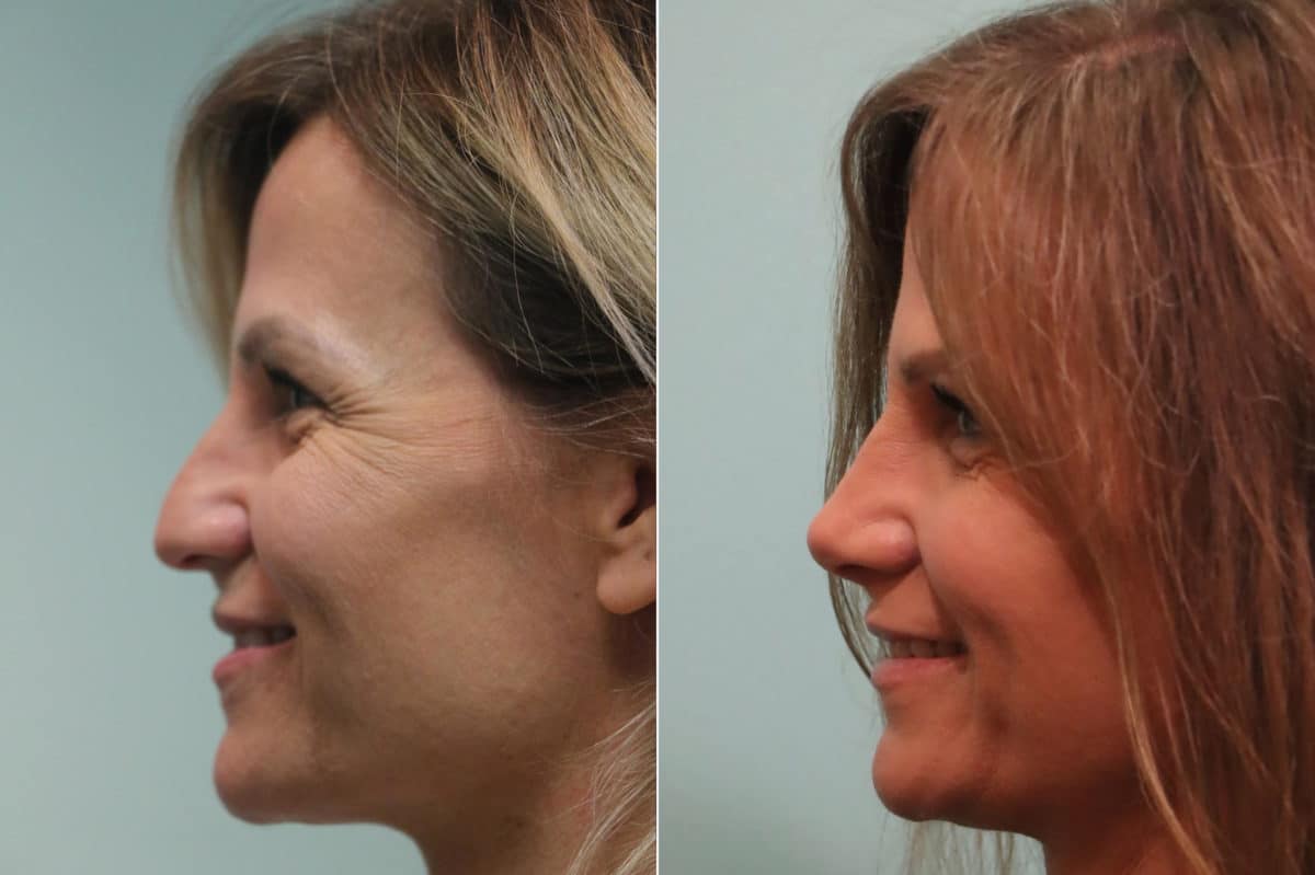 Before and after Rhinoplasty by Dr. Shervin Naderi, Patient 23470