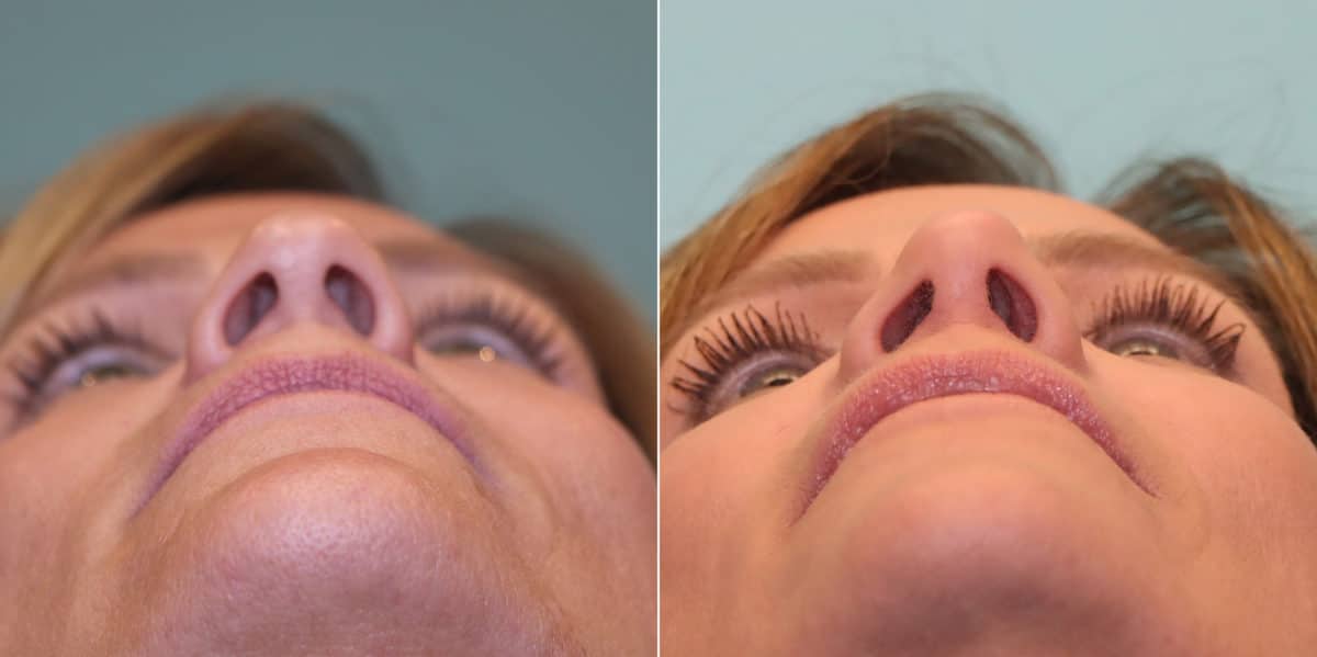 Before and after Rhinoplasty by Dr. Shervin Naderi, Patient 23470