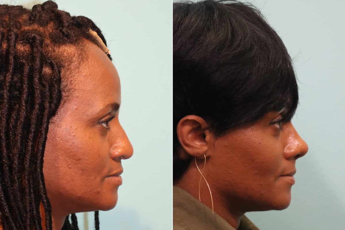 Before and after Rhinoplasty by Dr. Shervin Naderi, Patient 23471