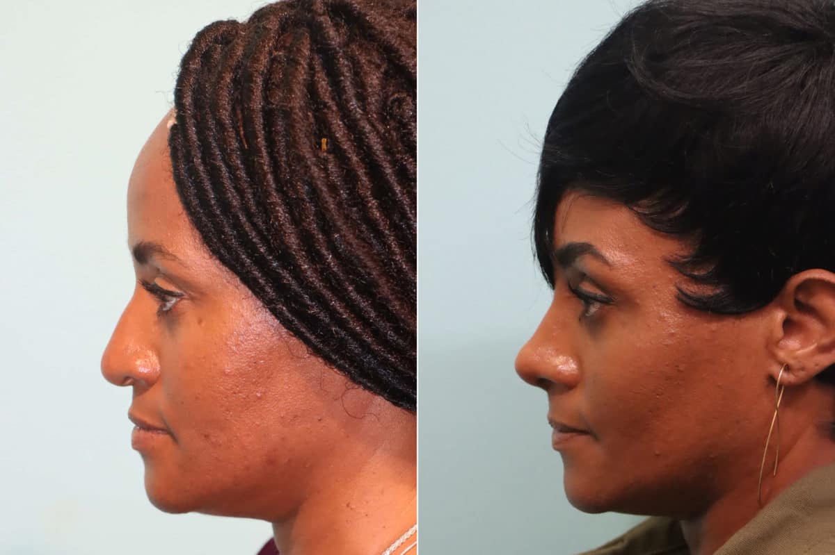 Before and after Rhinoplasty by Dr. Shervin Naderi, Patient 23471