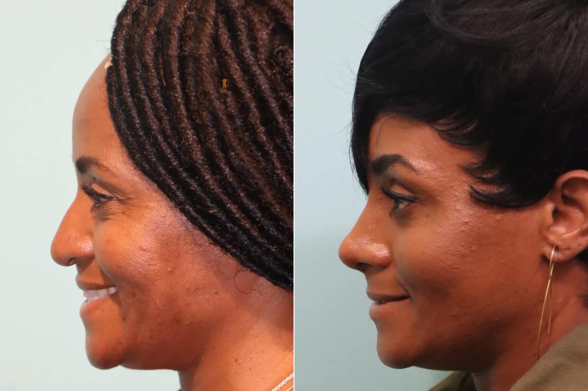 Before and after Rhinoplasty by Dr. Shervin Naderi, Patient 23471