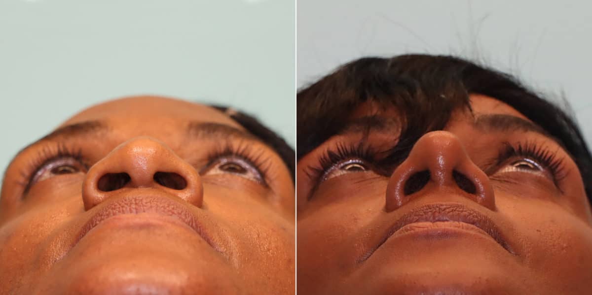 Before and after Rhinoplasty by Dr. Shervin Naderi, Patient 23471