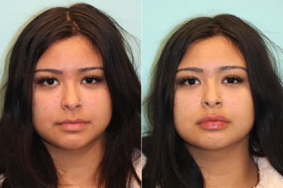 Before and after Lip Augmentation by Dr. Shervin Naderi, Patient 23547