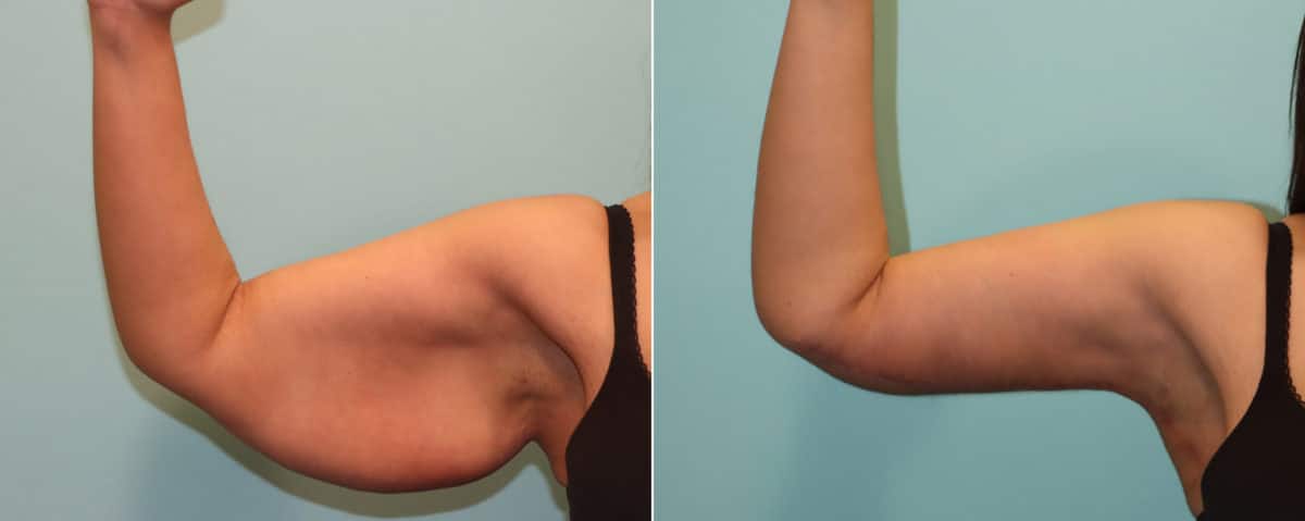 Before and after Brachioplasty (Arm Lift) by Dr. Shervin Naderi, Patient 23639